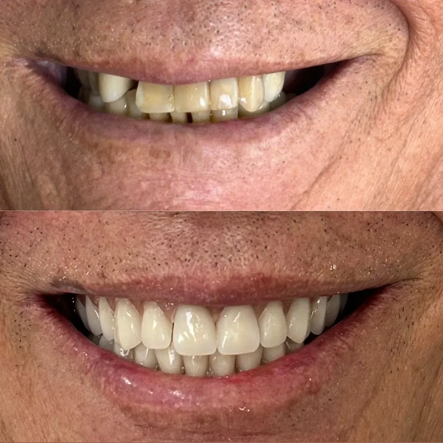 Detalhe do sorriso de um paciente antes e depois do tratamento reabilitador