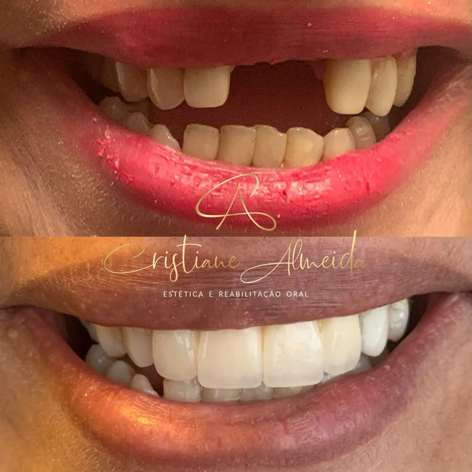 Comparação do sorriso de um paciente antes e depois do tratamento odontológico