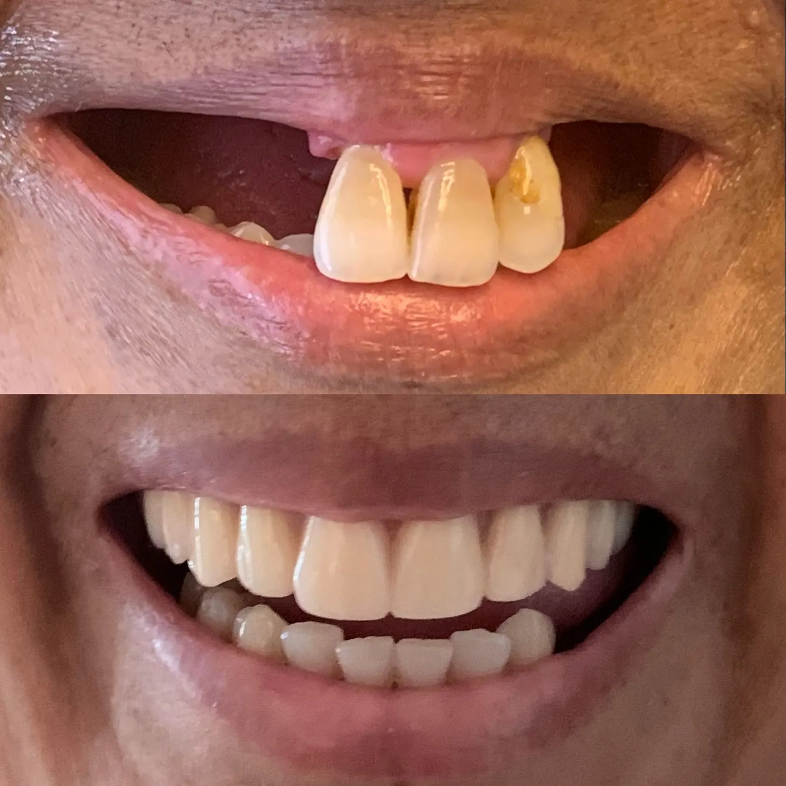 Sorriso de um paciente registrado antes e depois da reabilitação oral