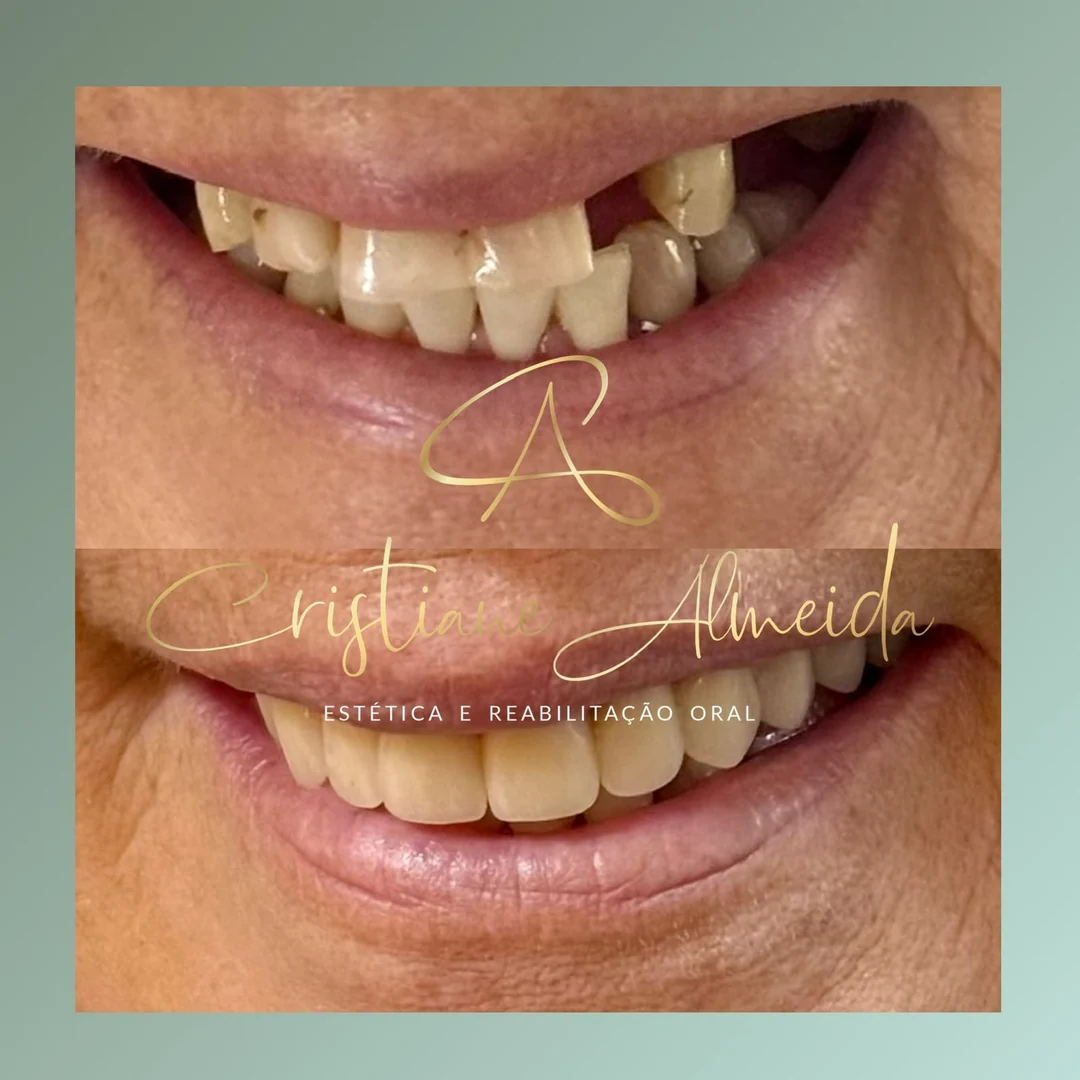 Fotografias comparativas do sorriso antes e depois de tratamento odontológico.