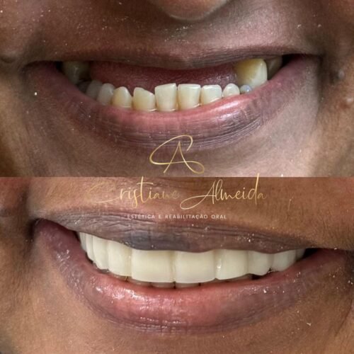 implante dentário
